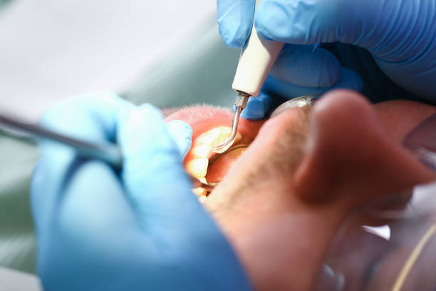 Best Emergency Dental Care for Broken or Chipped Teeth in North Patchogue, NY